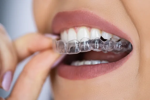 Mascherina trasparente Invisalign