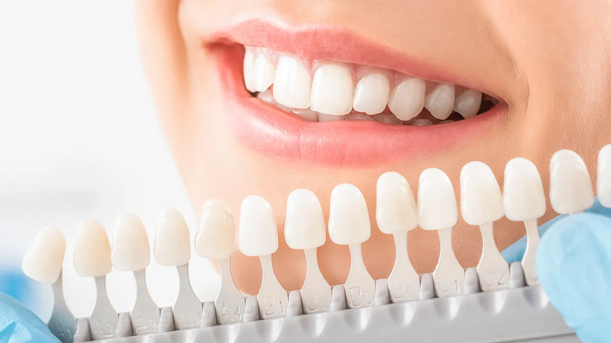 Faccette Dentali Estetiche