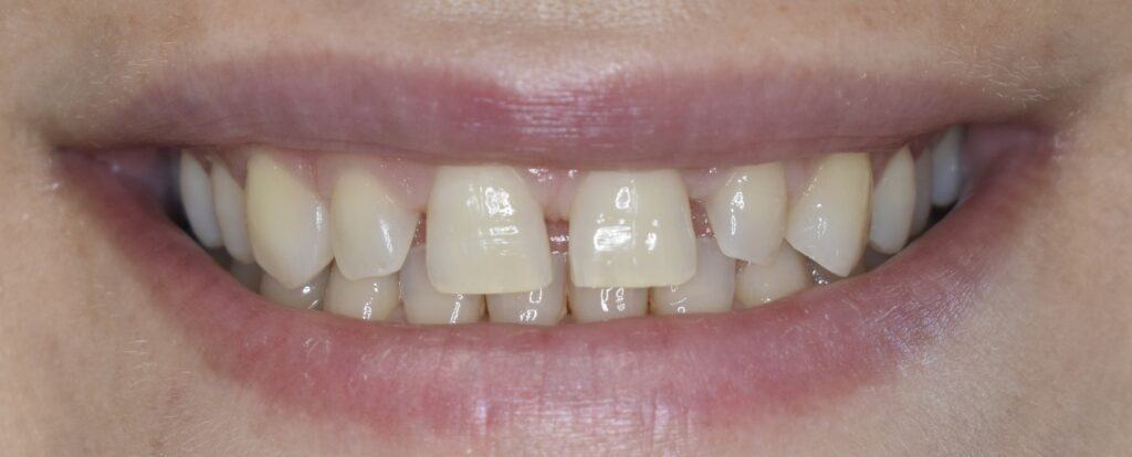 Faccette dentali a Battipaglia in ceramica integrale