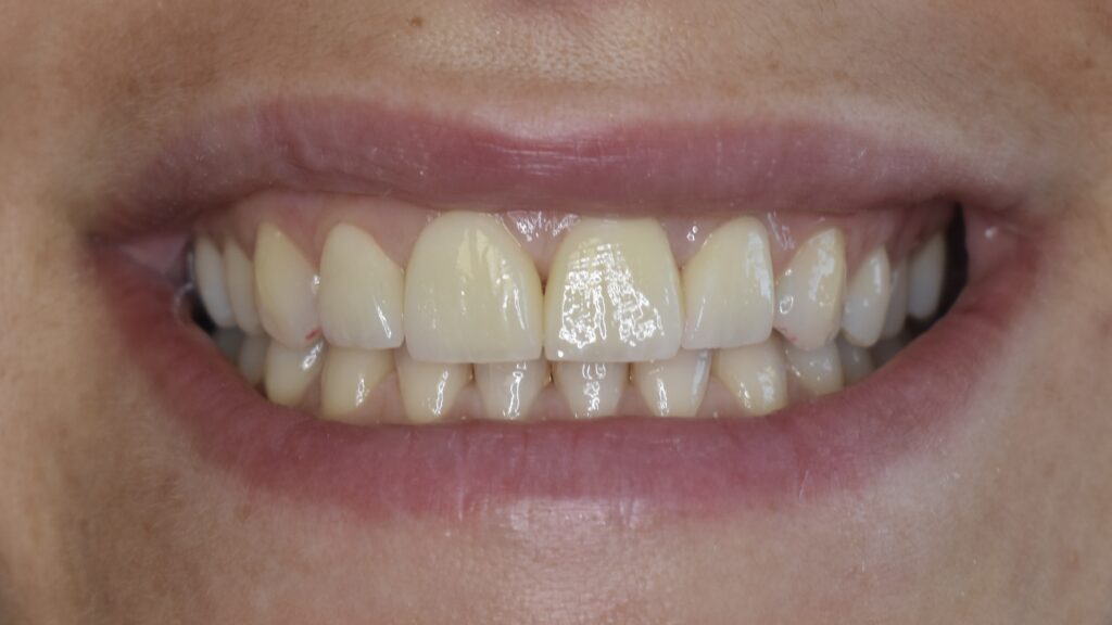 Faccette dentali a Battipaglia in ceramica integrale